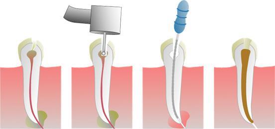 Malvern East Family Dental Root Canal Treatment
