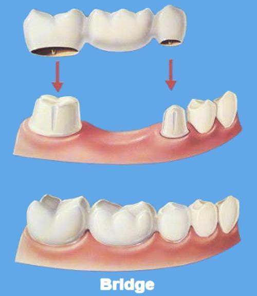 Malvern East Family Dental Bridges