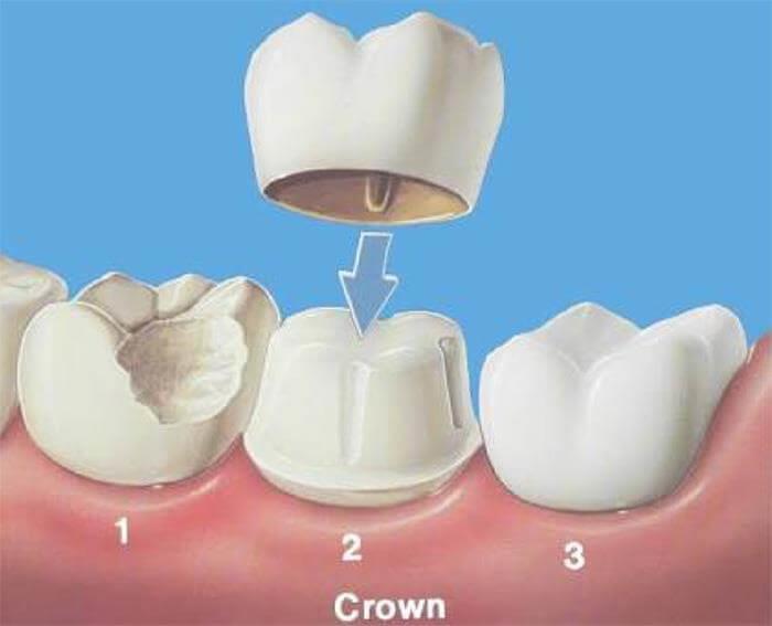 Malvern East Family Dental Crowns and Bridges
