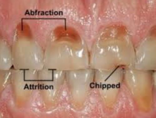 Malvern East Family Dental Toothwear Bruxism